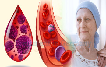 Treatment of Leukaemia in Germany: Innovative Medical Oncology Gives New Hope