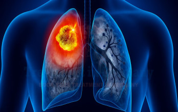 Stage 4 Lung Cancer Prognosis: Survival Rates and Treatment in Germany