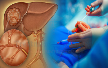 Liver Cancer Treatment with TACE Therapy in Germany