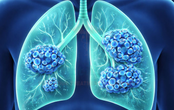 New Treatments for Small Cell Lung Cancer Stage 4