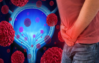 Survival Rate of Stage 4 Metastatic Bladder Cancer