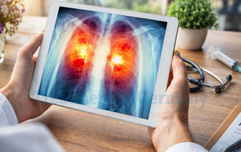 Immunotherapy for Stage 4 Small Cell Lung Cancer in Germany