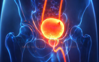 Metastatic Bladder Cancer Treatment Options in Germany