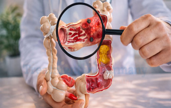 Advanced Colon Cancer Stage 4: Full 4 Stage Bowel Cancer Treatments Guide