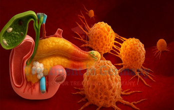 Advanced Pancreatic Cancer Treatment in Germany with Dendritic Cell-Based Immunotherapy