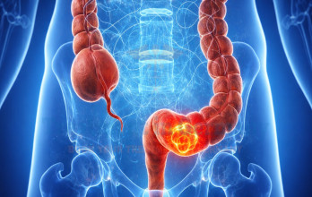 Stage 4 Colorectal Cancer Treatment Options in Germany