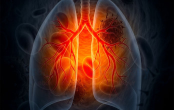 Immunotherapy Treatment for Stage 4 Lung Cancer in Germany