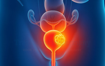 What Is the Survival Rate for Bladder Cancer in Germany
