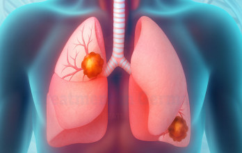 What Is Stage 4 Adenocarcinoma Lung Cancer?